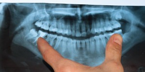 doctor shows a teeth in a x-ray picture